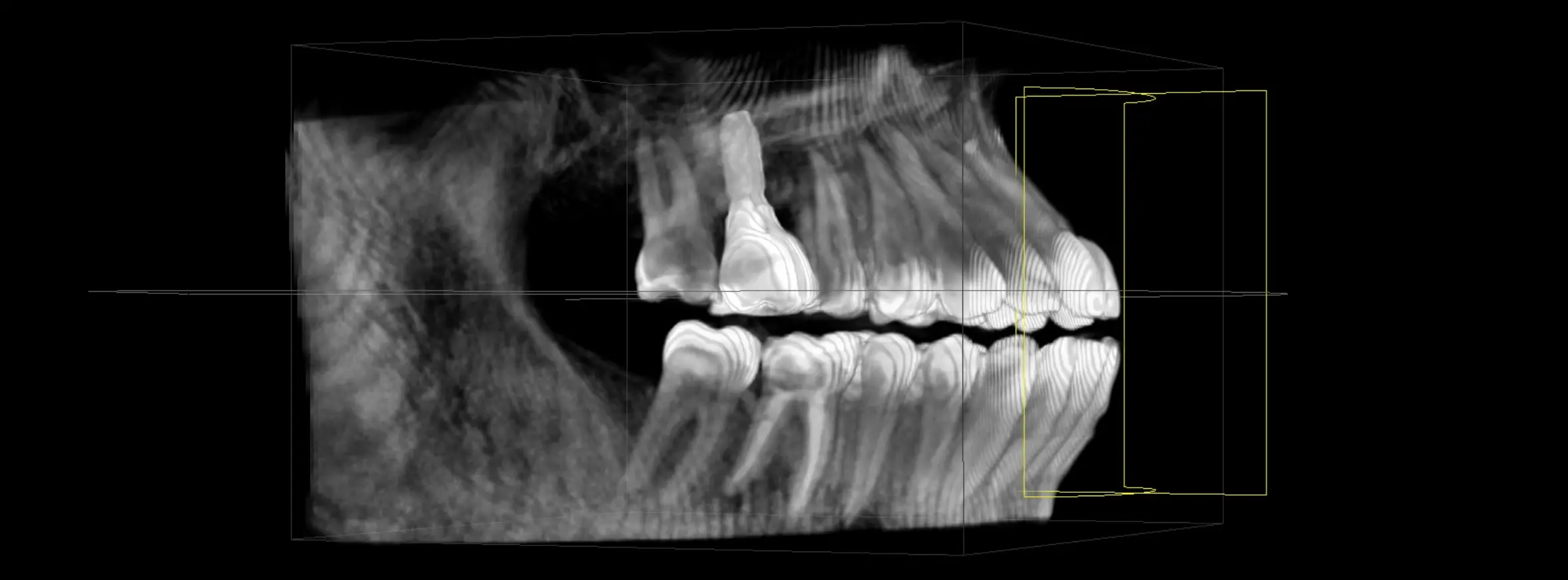 Implant, vue en 3D
