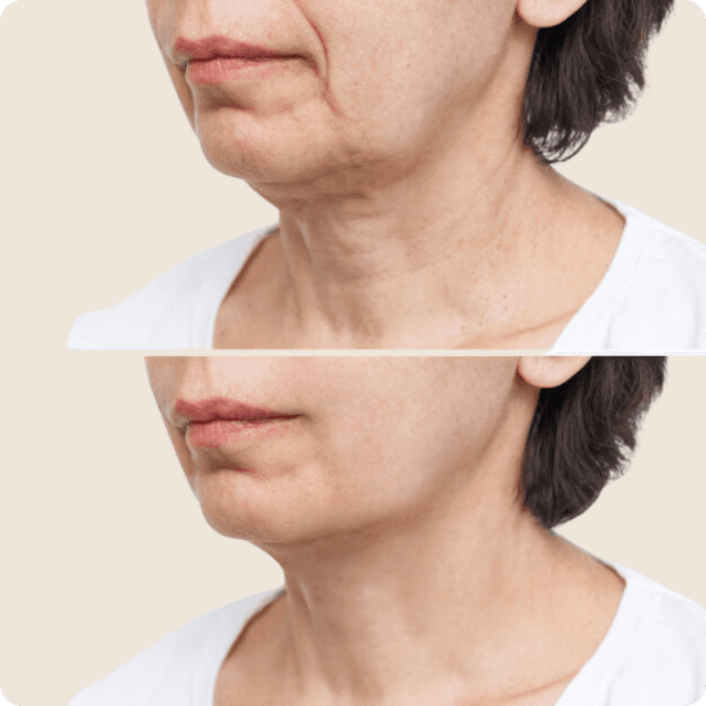 Before-and-after comparison of an older woman's neck after undergoing a neck lift. The 'before' image shows visible signs of aging, such as sagging skin and wrinkles around the neck area. The 'after' image highlights a smoother, firmer neck with improved contour and reduced skin laxity, reflecting the successful results of the surgical procedure. The woman appears pleased with her transformation, showcasing a more youthful and rejuvenated appearance.