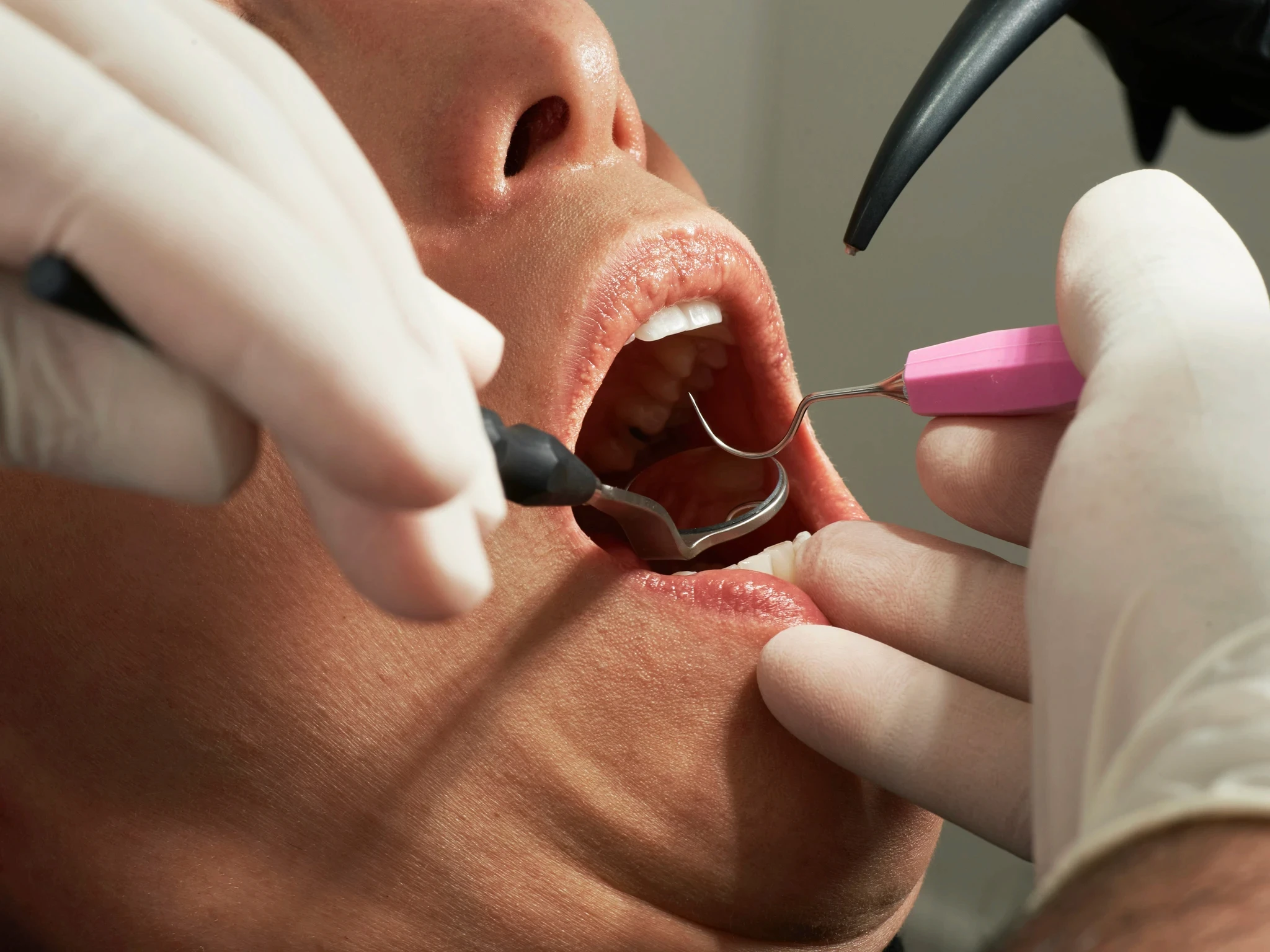 dental infection