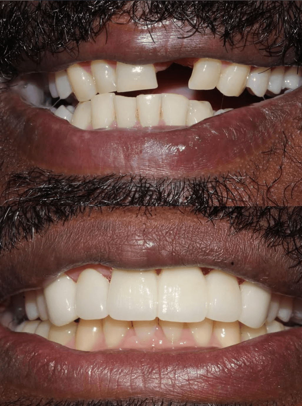 Before and After Bridges at ScarboroSmiles Dental Clinic in Scarborough, ON | Best dentist in Scarborough.