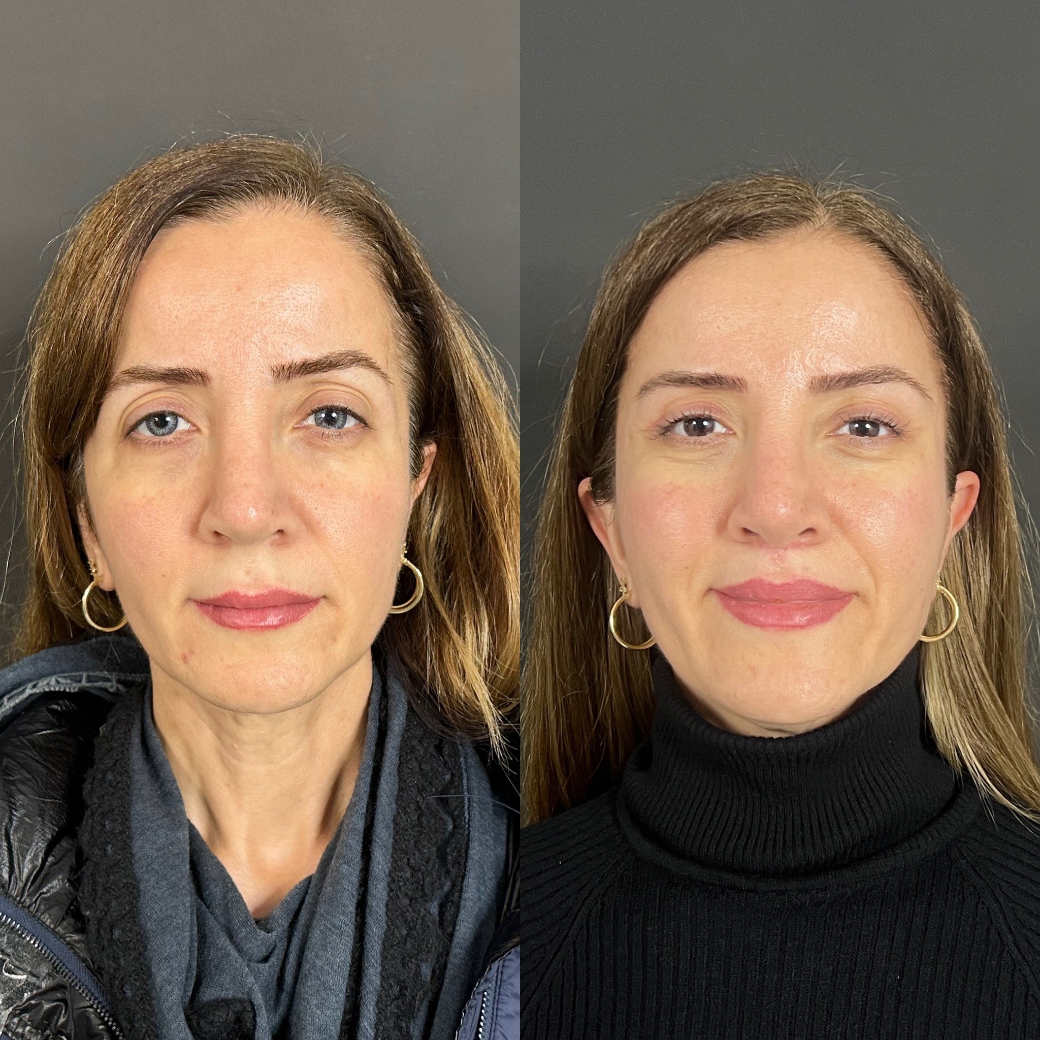 temporal lift and upper blepharoplasty before after front view