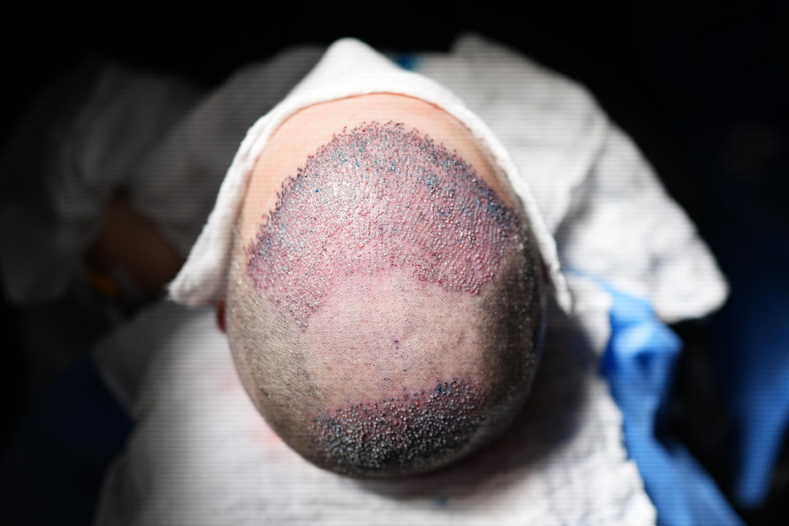 Cabeça de um paciente que passou por um transplante capilar durante o programa FUEx.