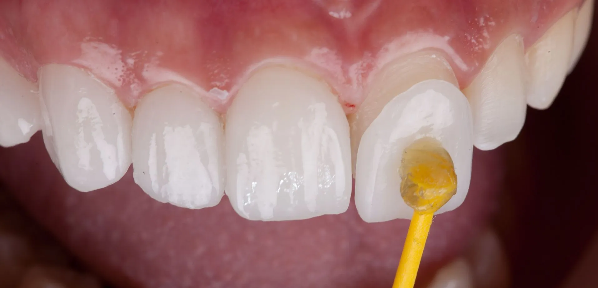 Facetas Dentárias: A solução para corrigir imperfeições