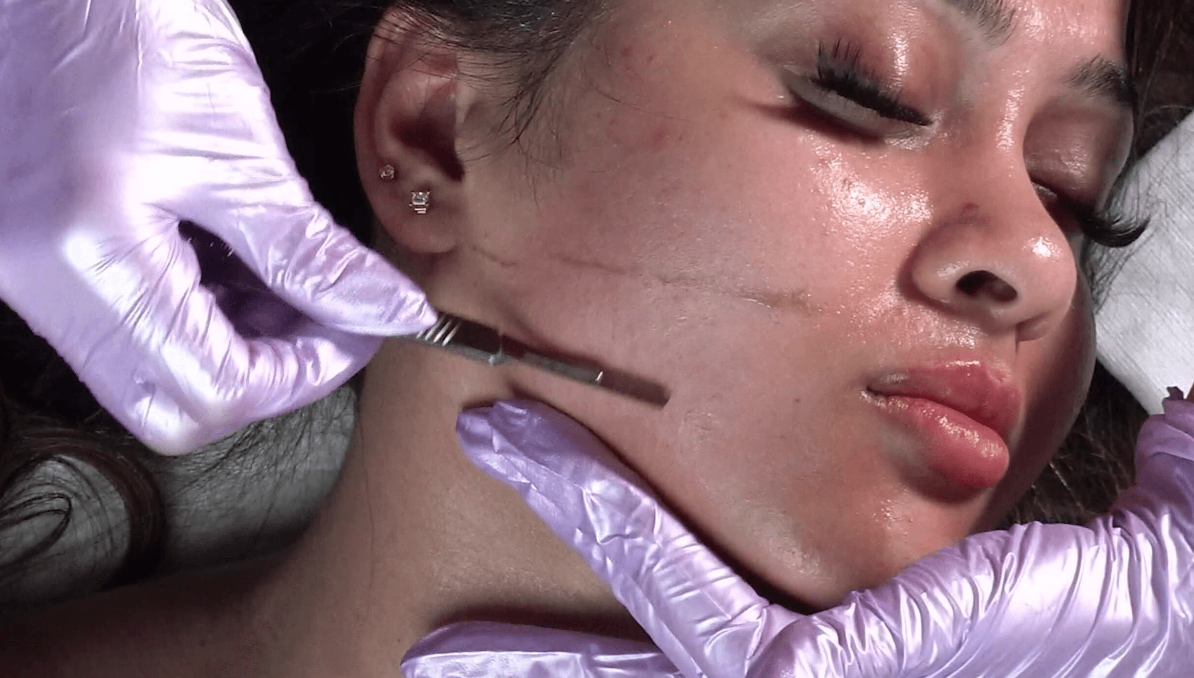 Dermaplaning pair with hydrafacial