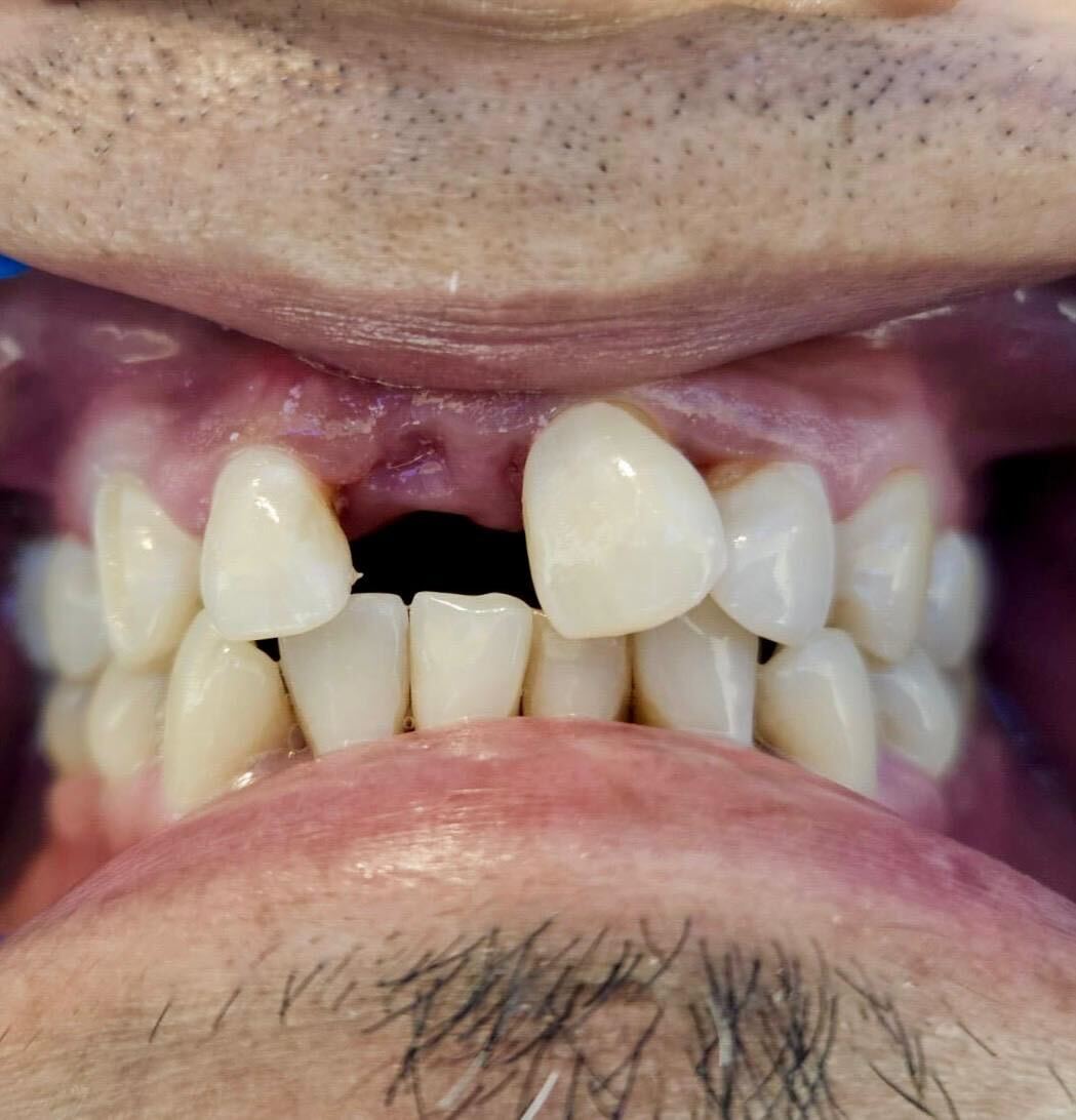 dental implant bridge work done in 24 hours