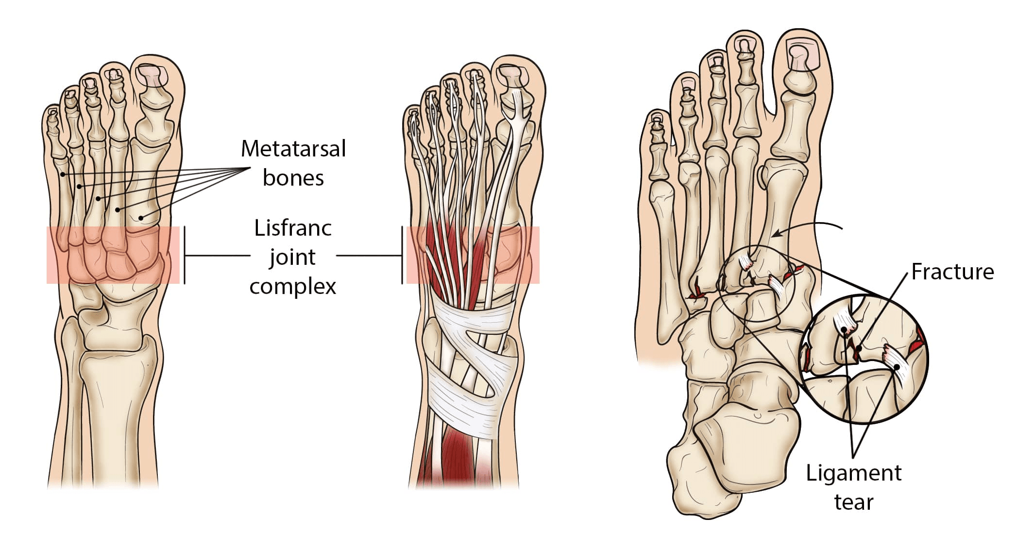 illustration of Lisfranc Injury Treatment