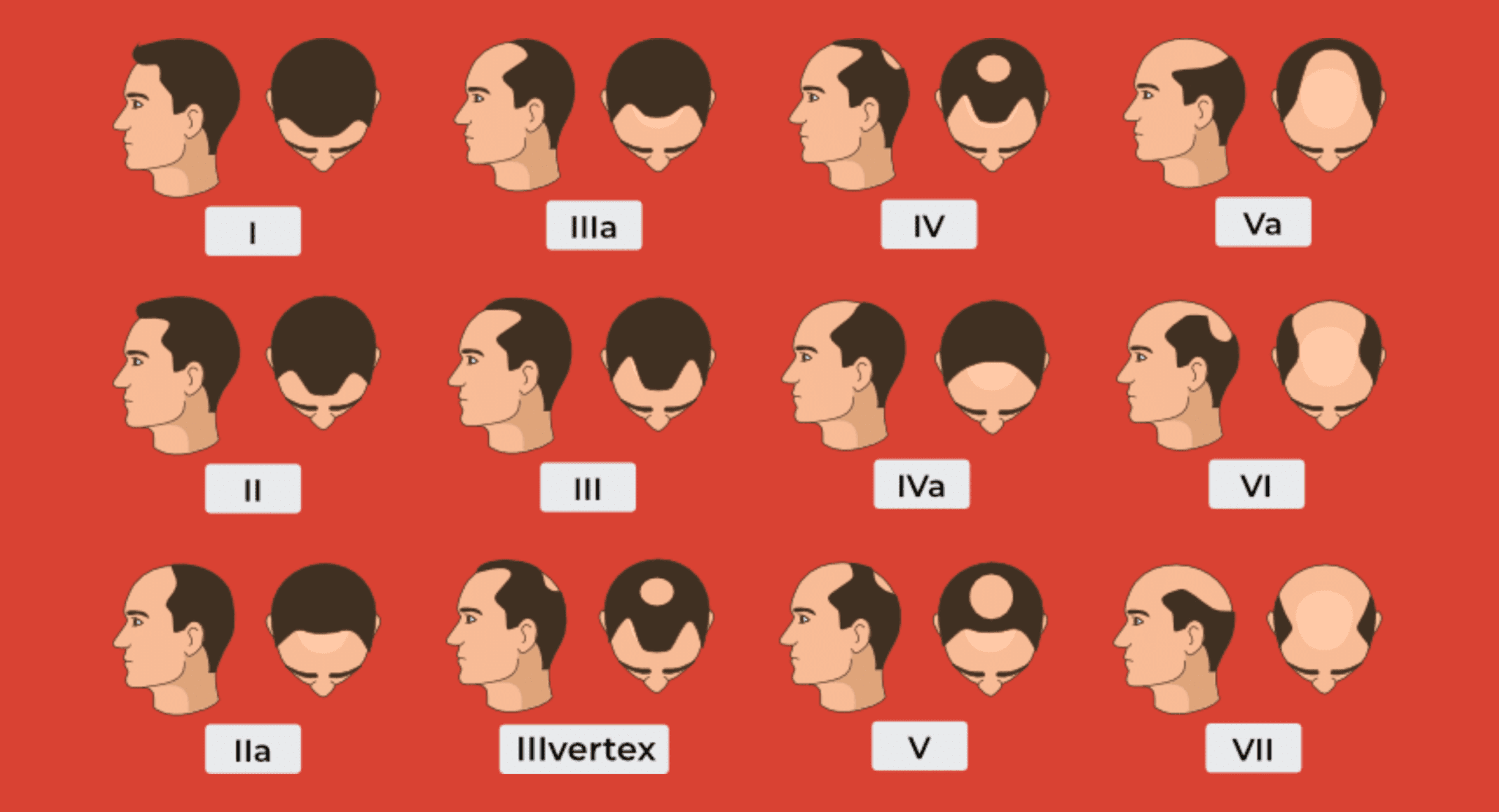 The picture shows the stages of hair loss from stage 1 to stage 7 . It showcases the growing hair loss in Men 