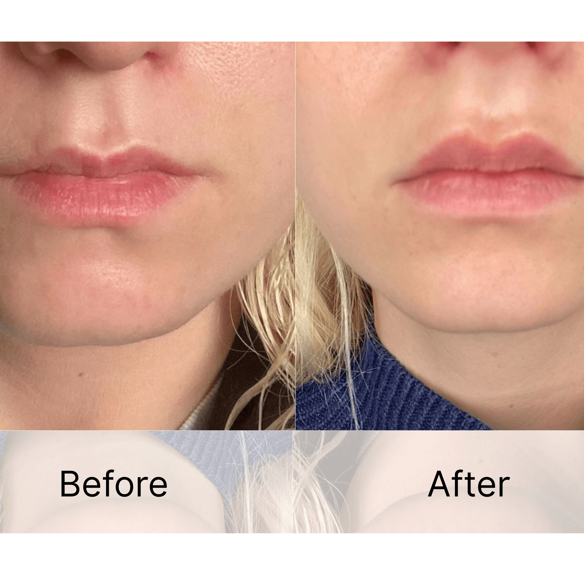 Poly(L-lactic Acid) Injectable Facial Filler Microspheres Factory