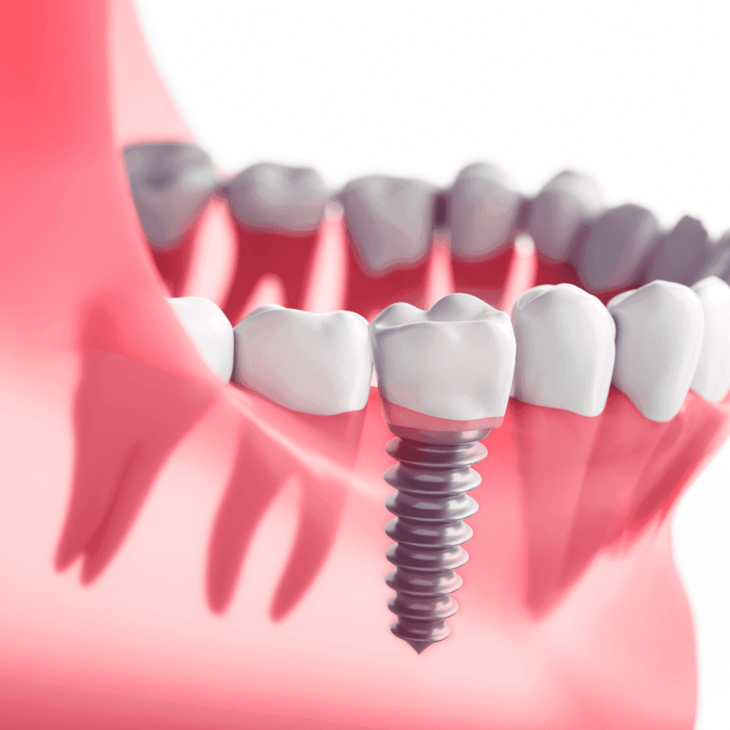 straumann implants