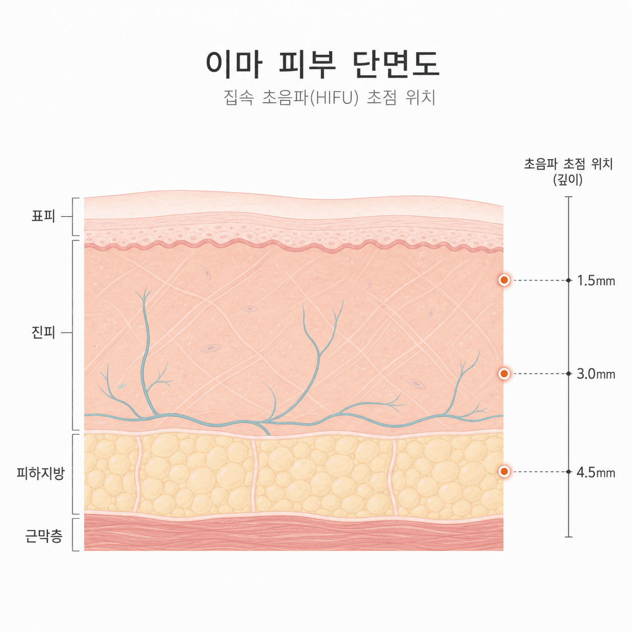 이마 피부층과 초음파 초점 깊이