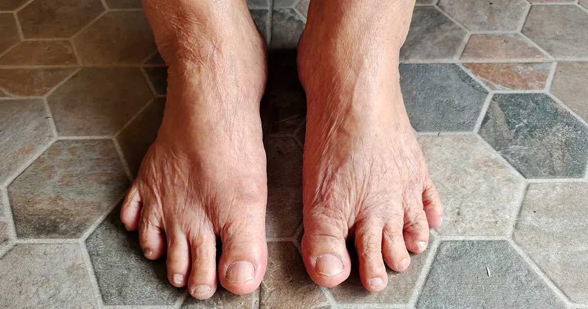 Illustrasjonsbilde av føtter som er helbredet for plattfot.