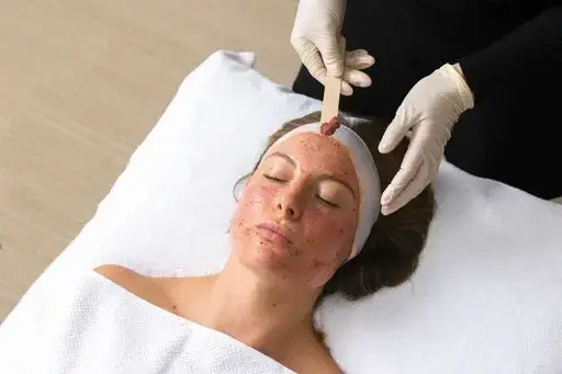 Woman undergoing medium-depth chemical peel treatment to refine skin texture, reduce pore size, and boost collagen renewal.