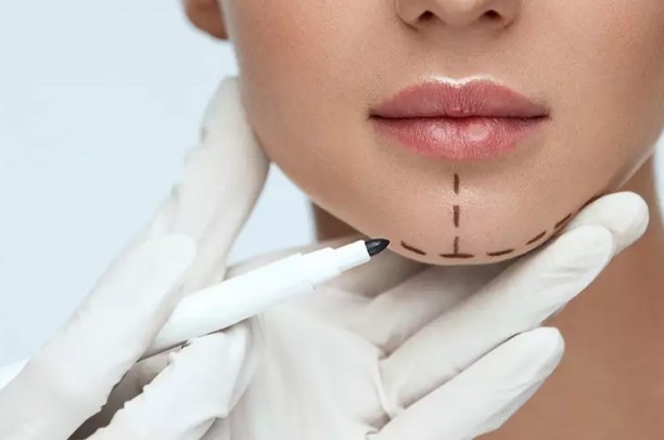 Mentoplastia (Cirurgia do queixo) - Dr Bruno Gomes Bucomaxilo