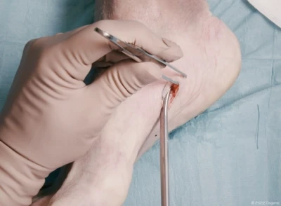 Skin lesion excision and undermining