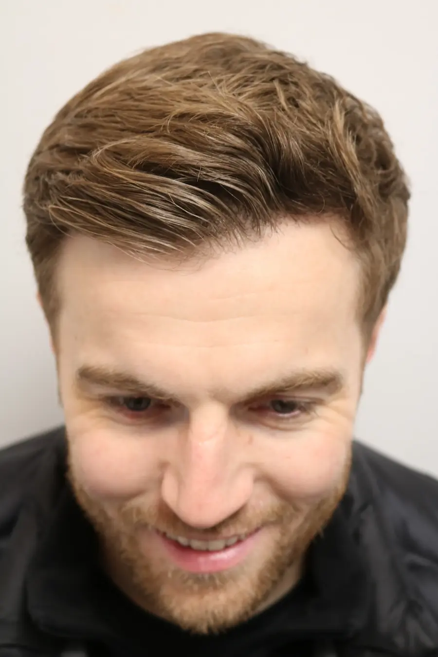After hair transplant – Lewis's FUE Hair Transplant Result