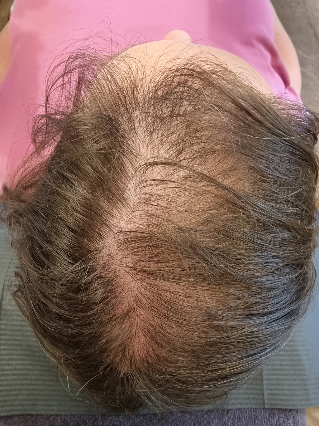 Micro haar pigmentatie Alluris