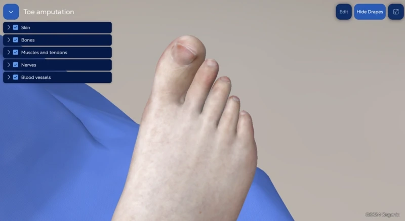 Toe amputation