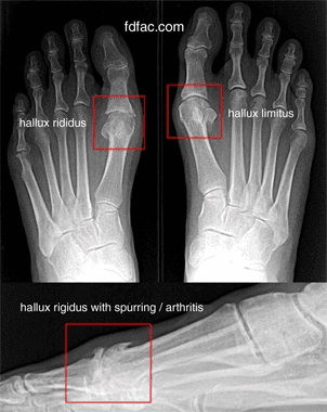 x-ray of Hallux Limitus/Rigidus Surgery