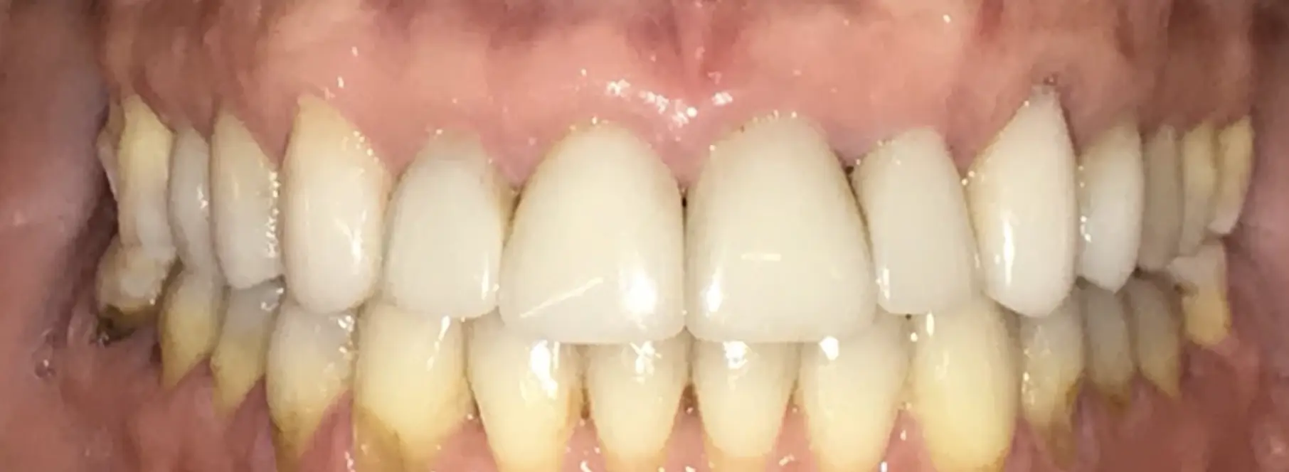 Temporary crowns on frontal teeth, changing old composite restorations (before and after)
