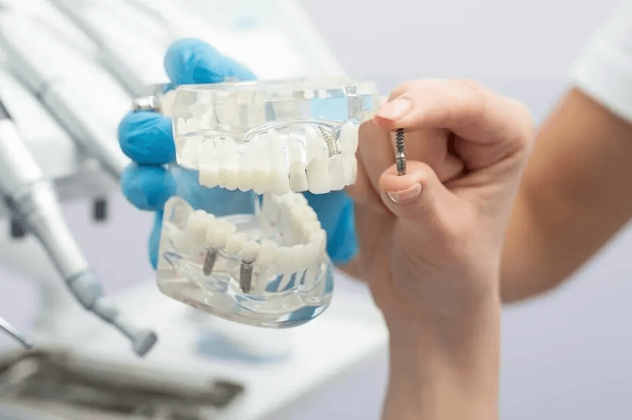 dental implants maintenance