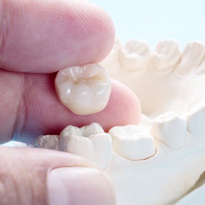 same day dental crowns