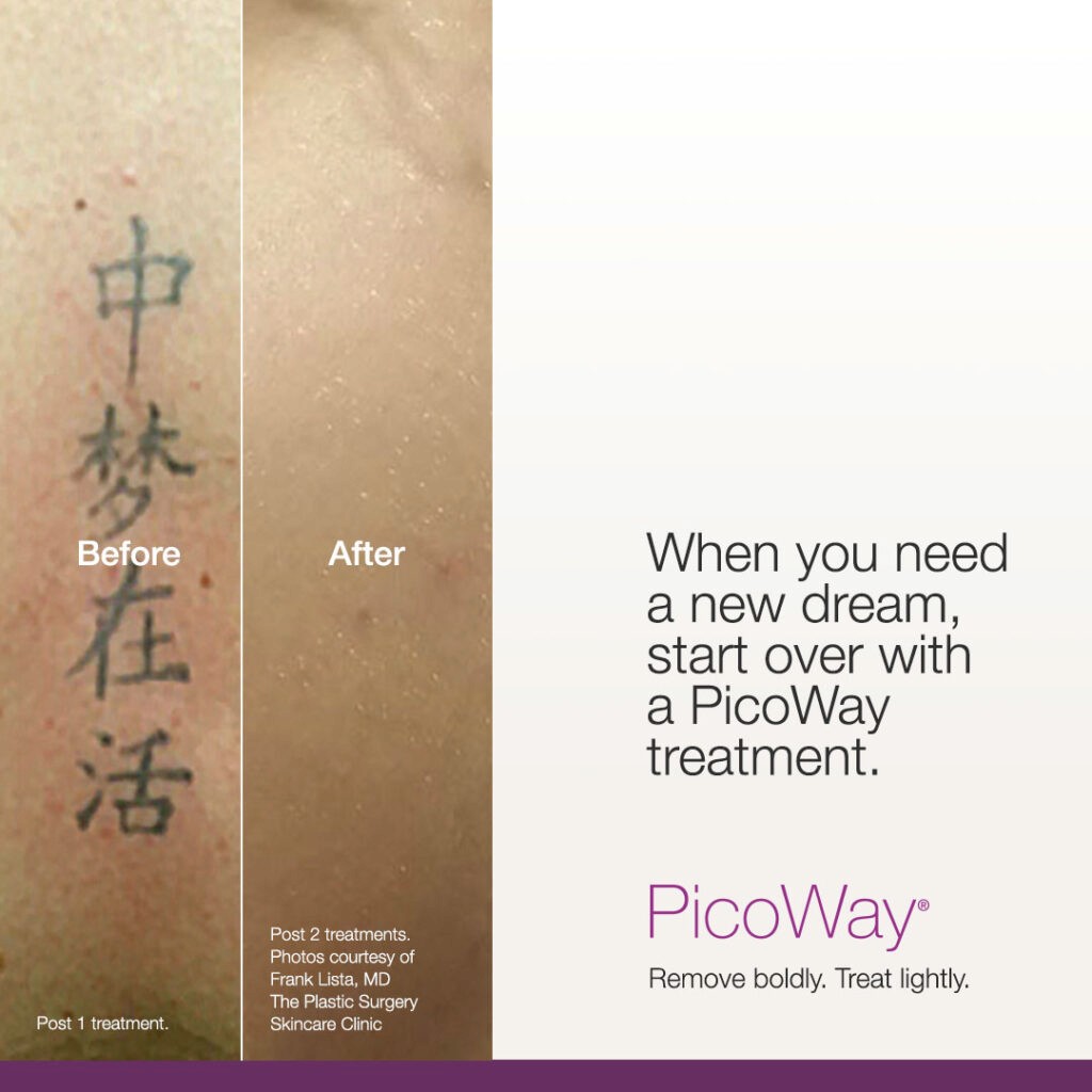 Before and after laser tattoo removal
