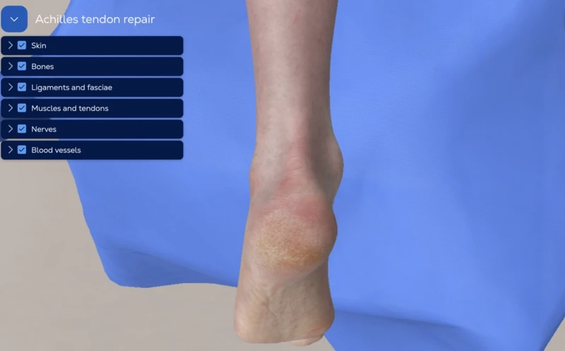 Achilles Tendon Repair