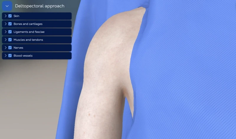 Deltopectoral approach