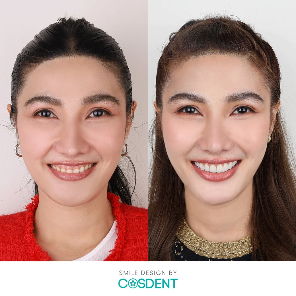 รีวิวออกแบบรอยยิ้ม ที่ cosdent smile design