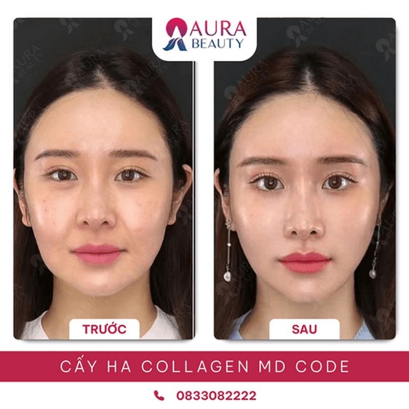 Kết quả tiêm Ha Collagen tại Thẩm mỹ viện Aura