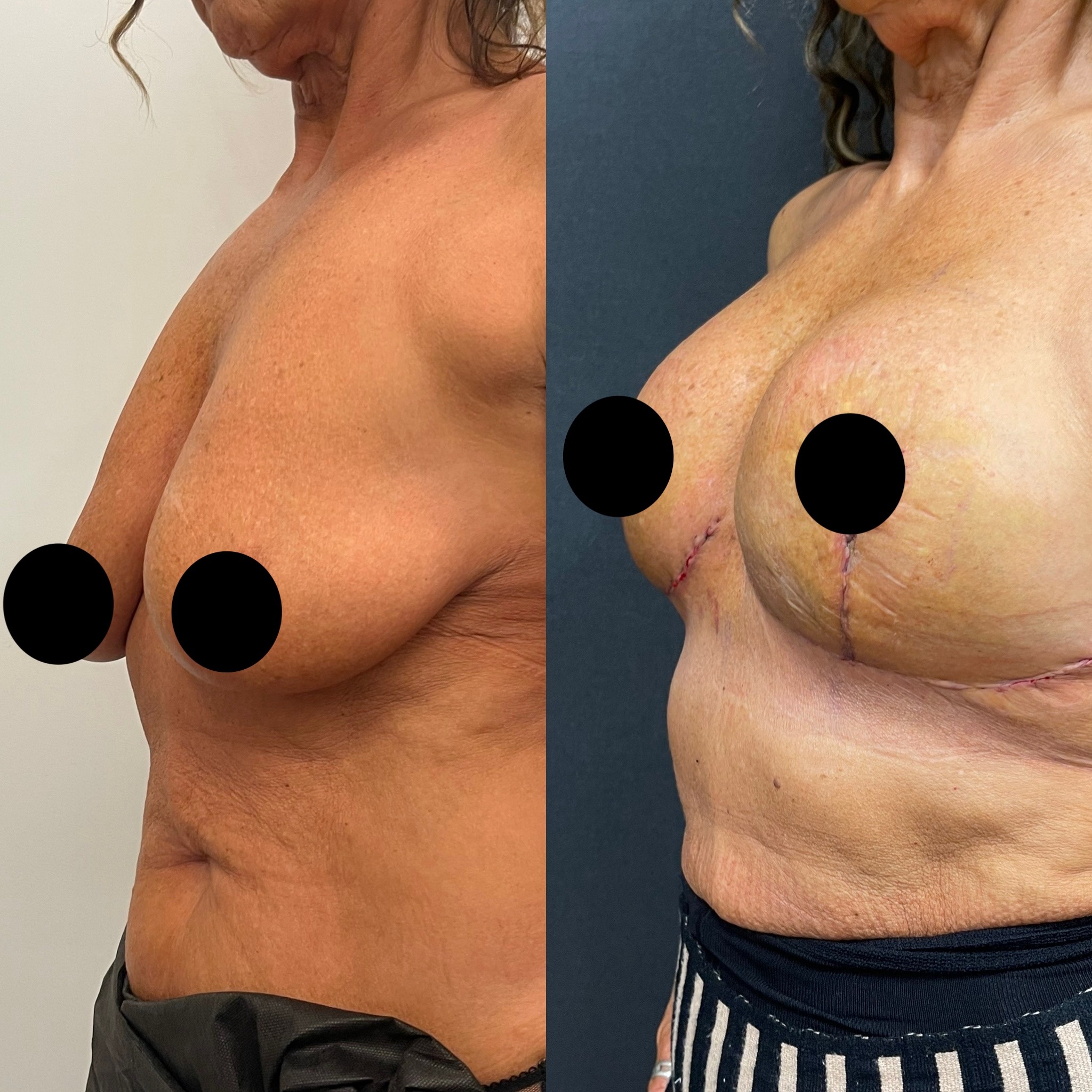 breast lift before after 3 days post-op left oblique view