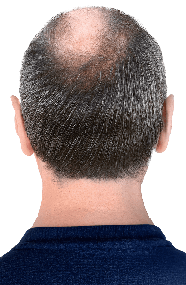 Free hair type analysis before hair transplantation & Personalized treatment plan