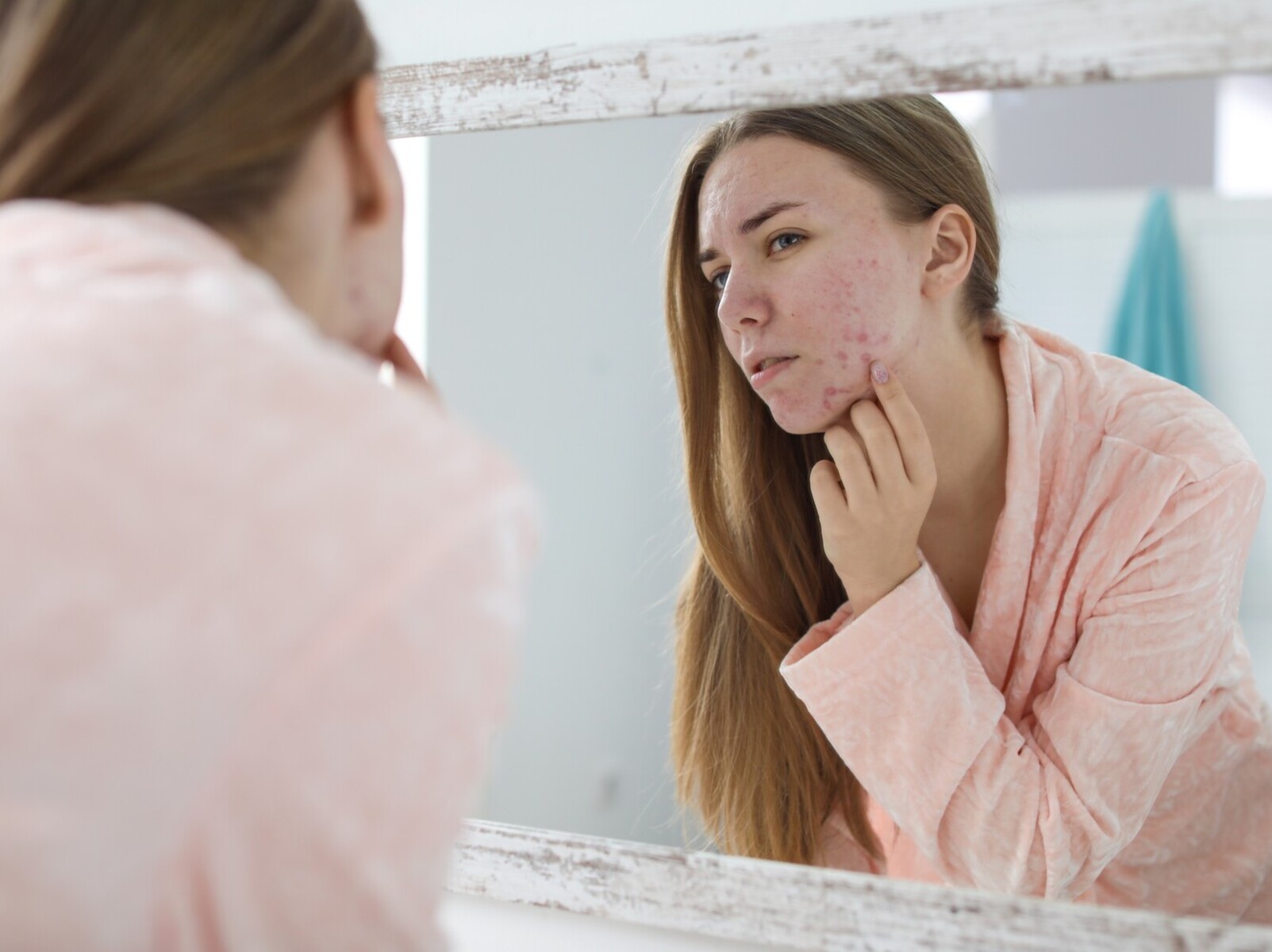 young woman concerned about her acne while deciding on a birth control that doesn't make you gain weight