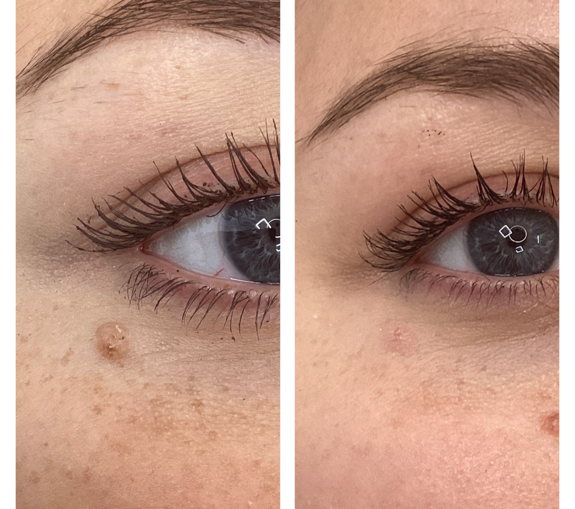 Laser treatment on woman's cheek with protective eye shield