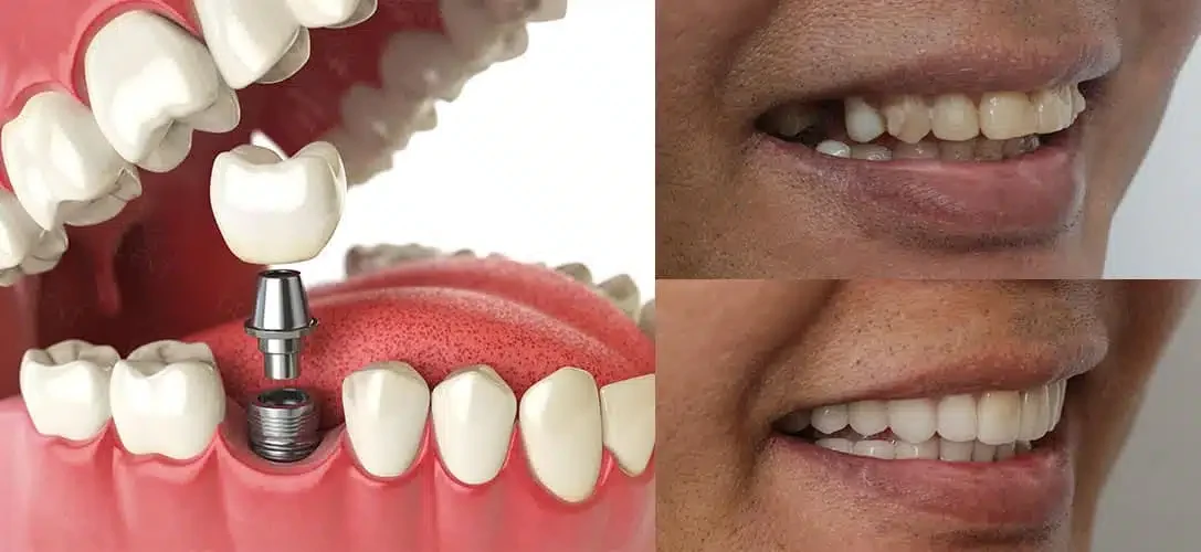Dental implant treatment planning at COSDENT Smile Design