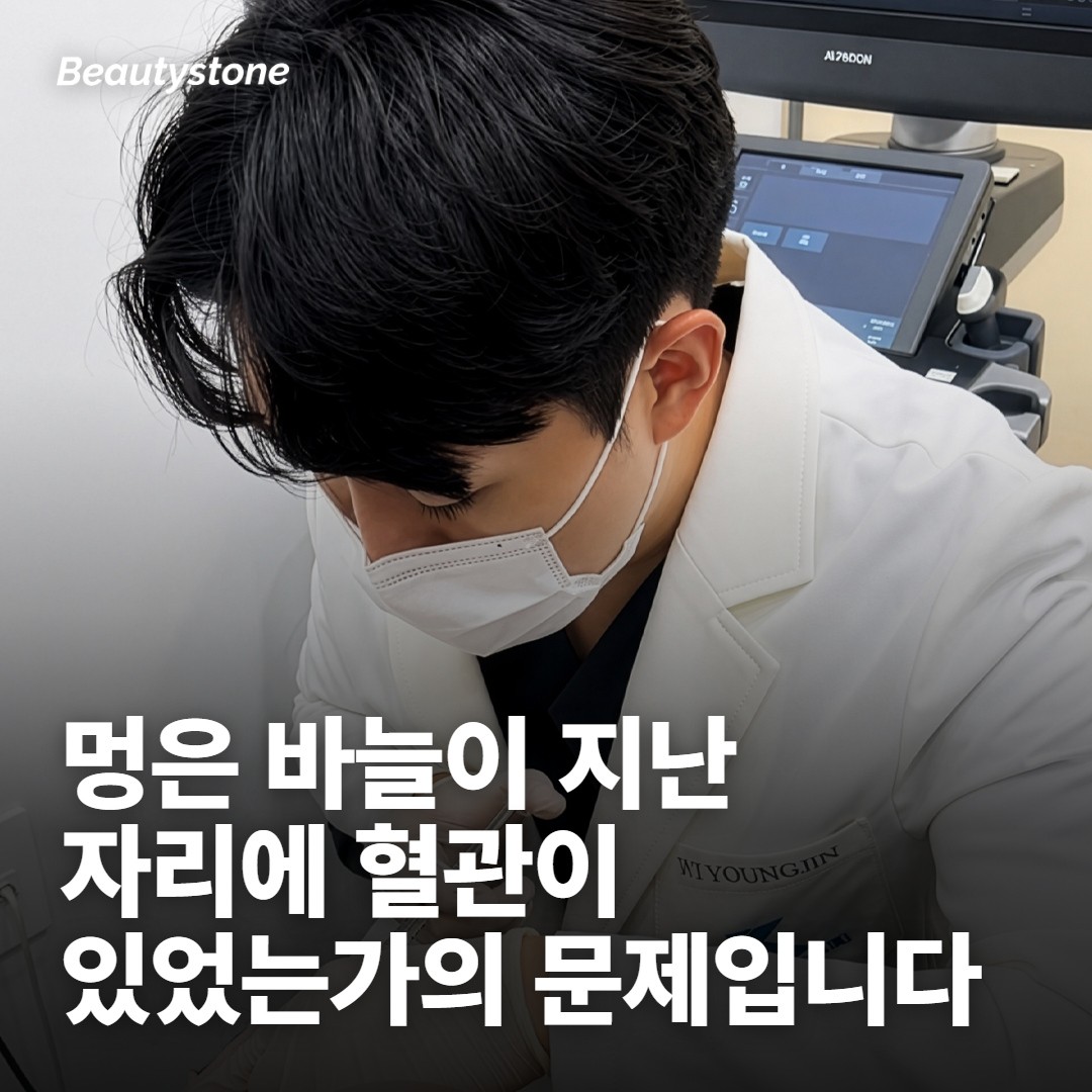 포텐자 멍은 바늘이 혈관을 지난 자리에 생깁니다