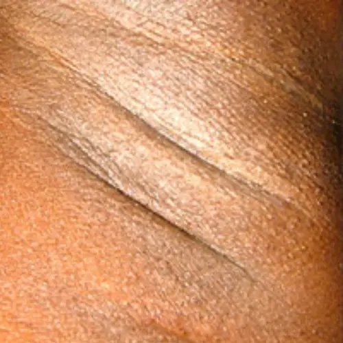 After laser hair removal at The Vancouver Aesthetician — underarm and intimate area hair removed and pigmentation corrected safely on melanin-rich skin
