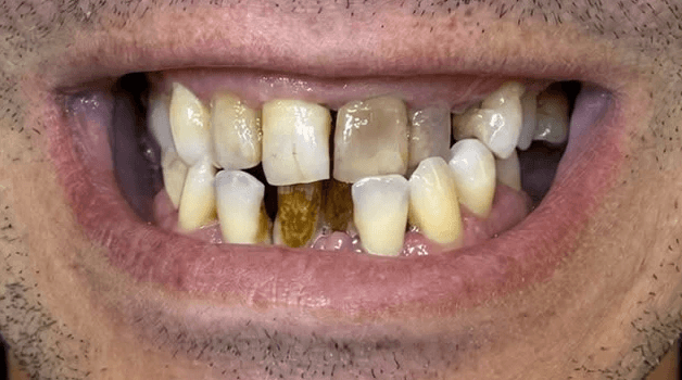 Before treatment