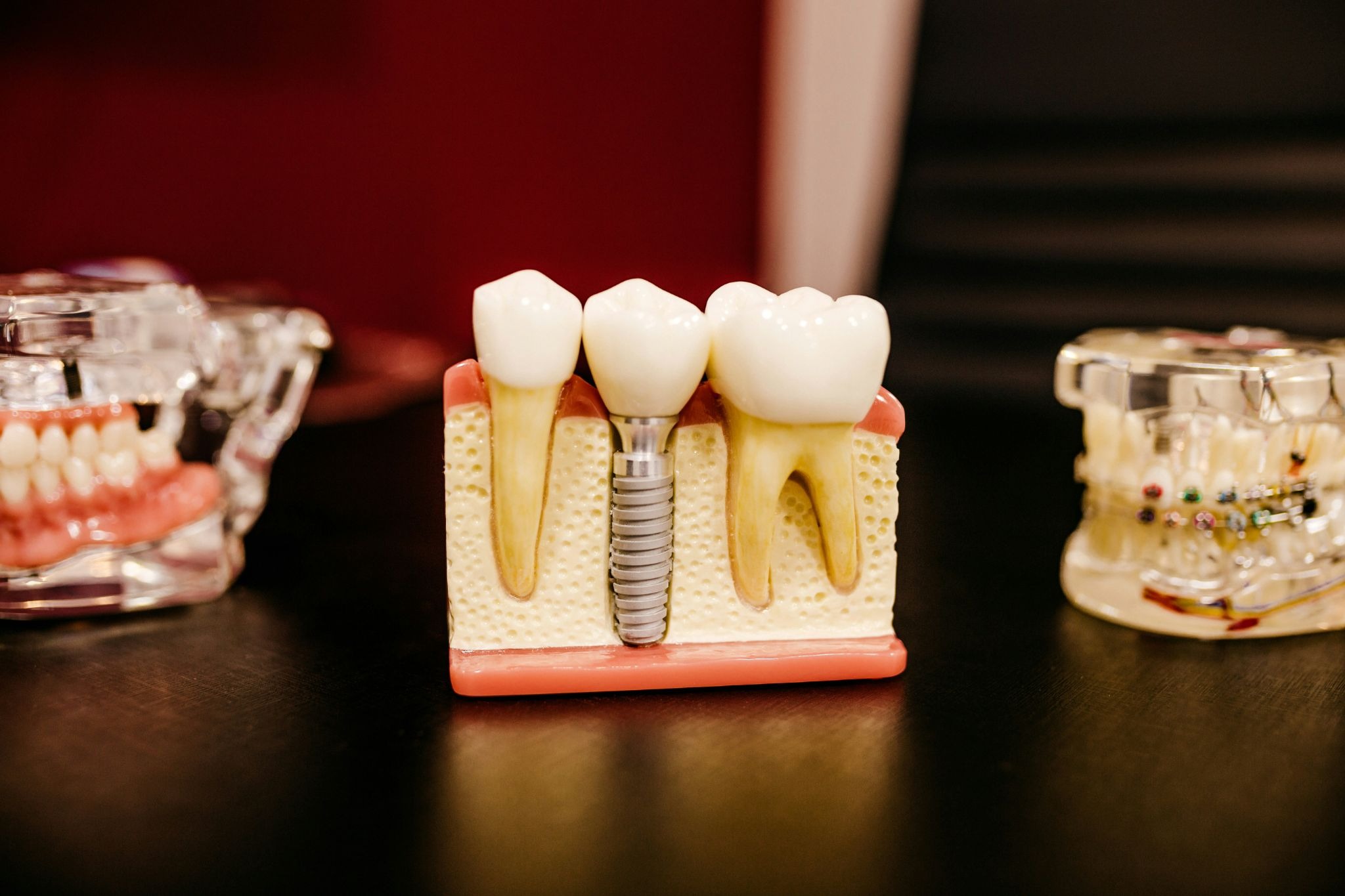 Dental Implants vs Bridges: How to Know What's Best