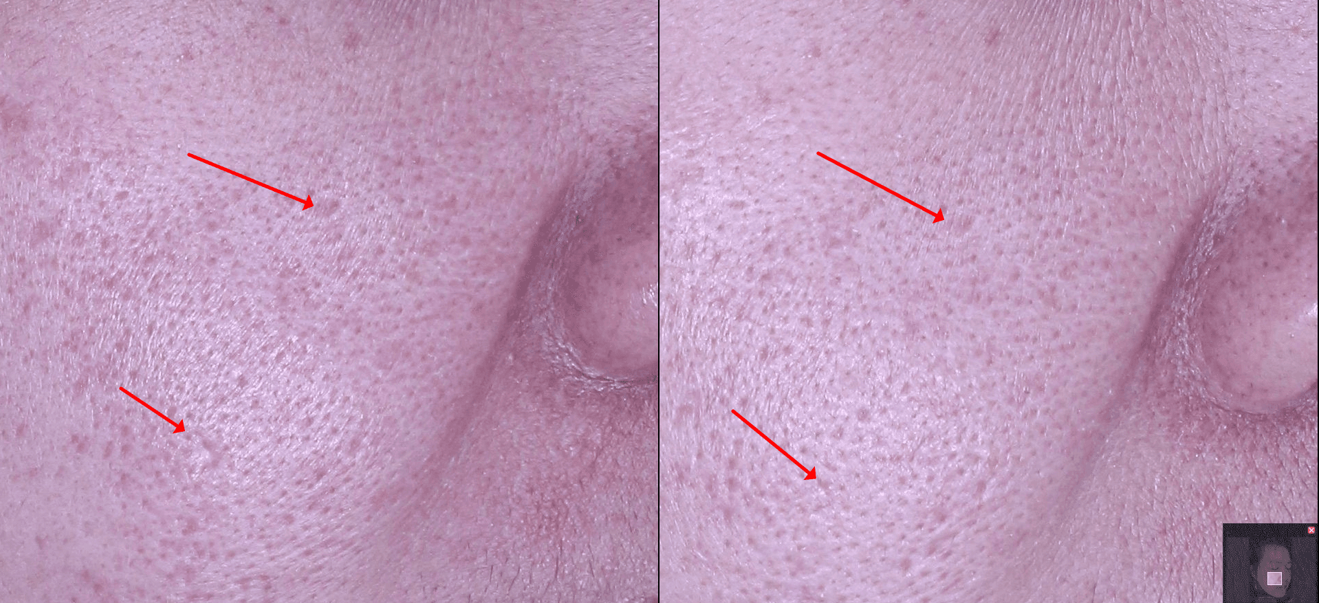 毛孔/美容针/疤痕/痘疤/pore/scar