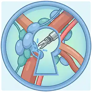 Penile Cancer का Icon. Minimally invasive स्कीमैटिक of the inguinal lymph nodes. एक robotic उपकरण keyhole incision के माध्यम से R-VEIL (Robotic Video Endoscopic Inguinal Lymph Node Dissection - रोबोटिक वीडियो एंडोस्कोपिक इन्गुइनल लिम्फ नोड डिसेक्शन) करता है, जिसमें लिंफेडेमा की रोकथाम को प्राथमिकता दी जाती है।