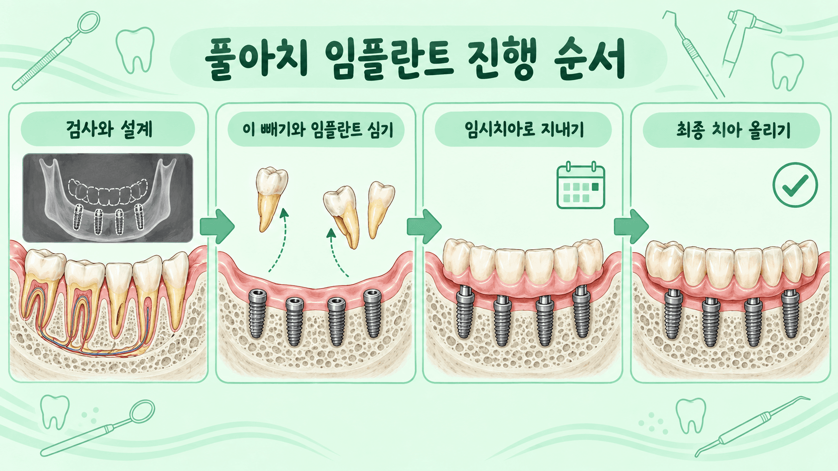 검사와 설계, 이 빼기와 임플란트 심기, 임시치아로 지내기, 최종 치아 올리기까지 풀아치 임플란트 진행 순서를 그린 일러스트