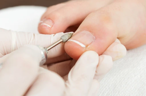 발톱무좀 치료 전 손상된 발톱을 정리하는 의료 시술 과정