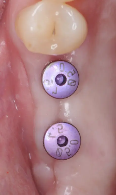 Deux implants remplaÇant des dents postérieures manquantes
