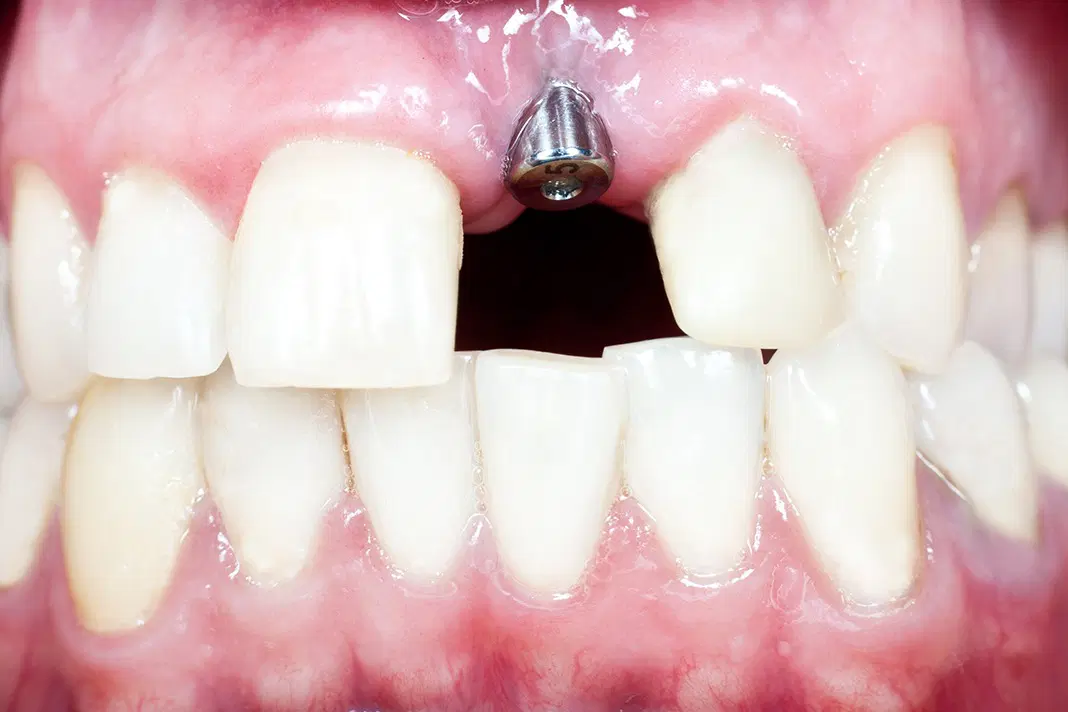 dental implant