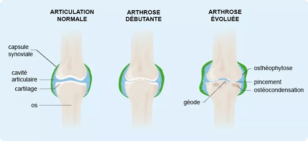 schema arthrose genou