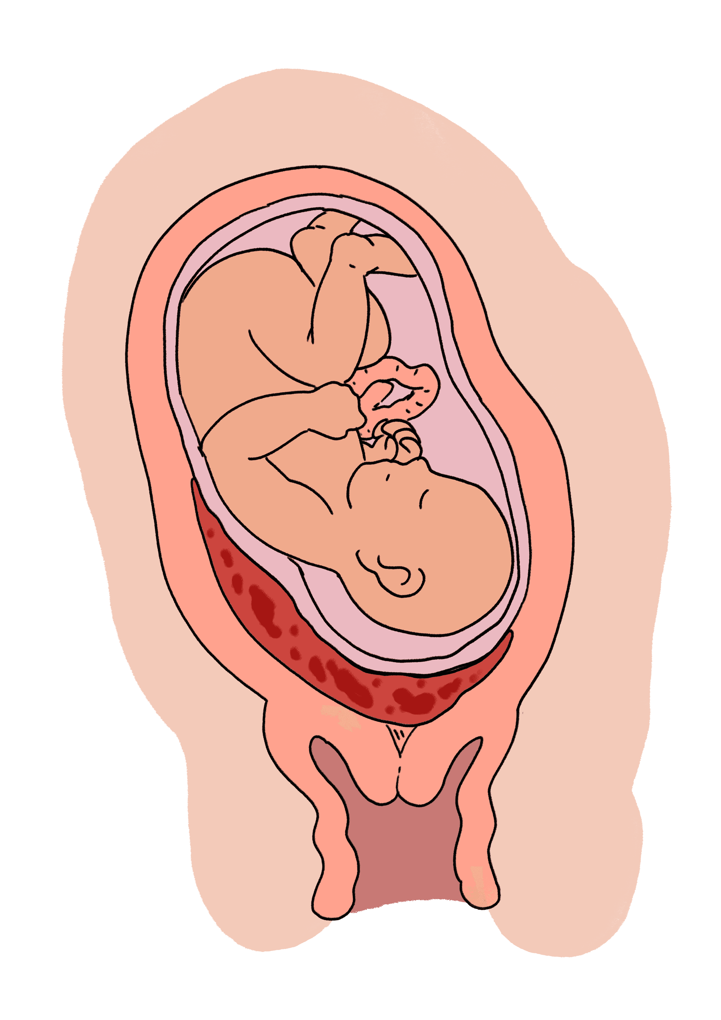 A cross section illustration showing the baby head down in the womb. The placenta is lying under the baby's shoulders and head blocking the baby's way out through the vagina.