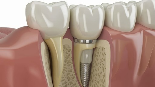 Dental Braces