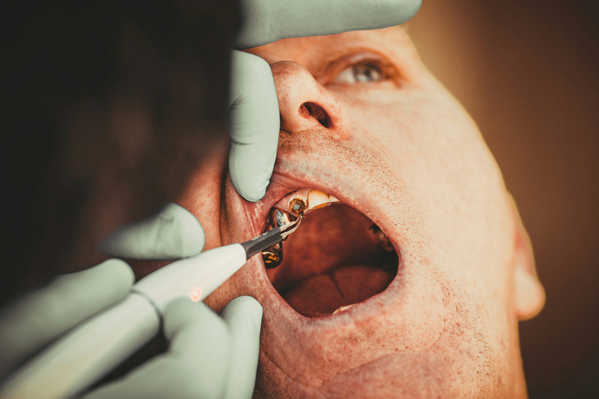 Chipped tooth