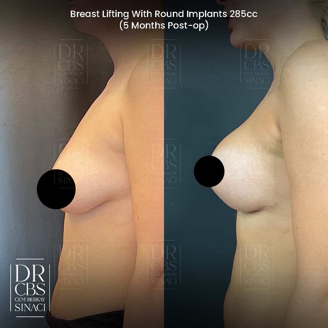 breast lift with implant 6 months before after side view